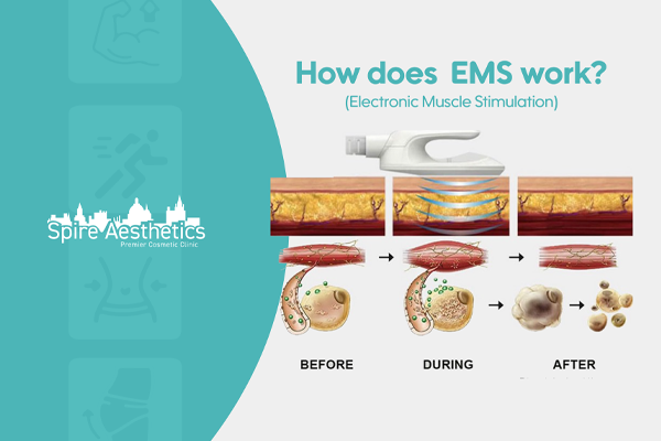 EMS treatment for post pregnancy weight loss treatment Herefordshire