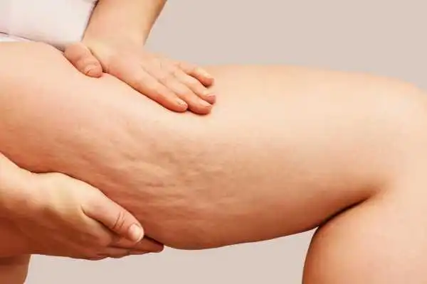 Image of woman showing leg with cellulite Herefordshire