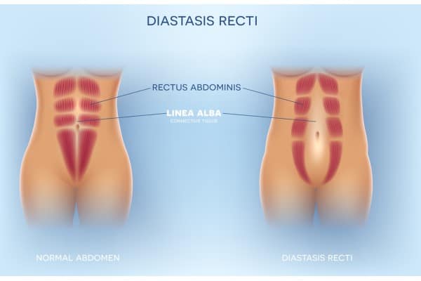 What Non-Surgical Options Are Available for Diastasis Recti Herefordshire?