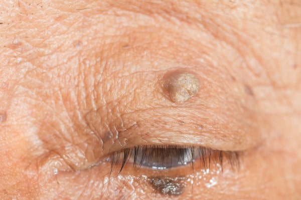 Skin imperfections Herefordshire - Cryopen is fast and effective book in today!