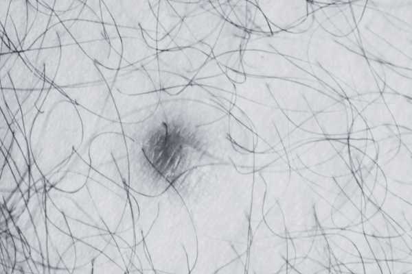 Dermatofibroma removal Herefordshire made simple! Book in today!