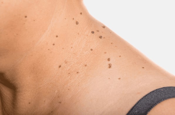 Are you looking for easy skin tag removal Herefordshire - then contact Spire today!