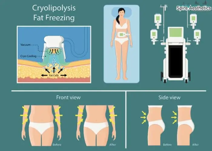 Fat freezing treatment Herefordshire benefits for competitions to remove stubborn fat deposits.