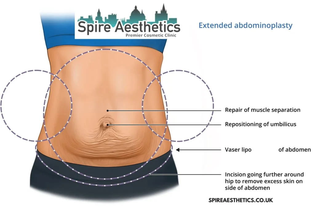 Understanding Loose Skin After Gastric Band Herefordshire Surgery and HIFU Treatment