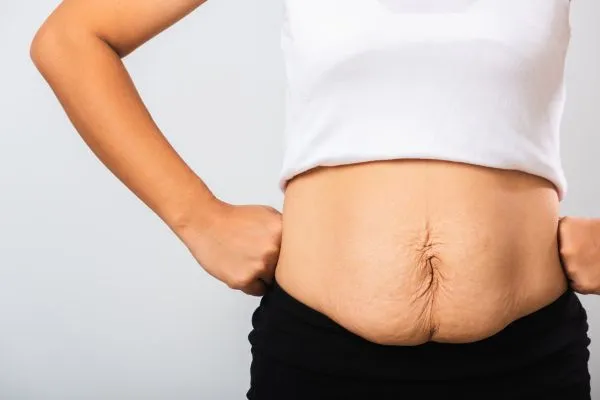 Image of a woman's stomach after weight loss with sagging skin following a gastric band Herefordshire