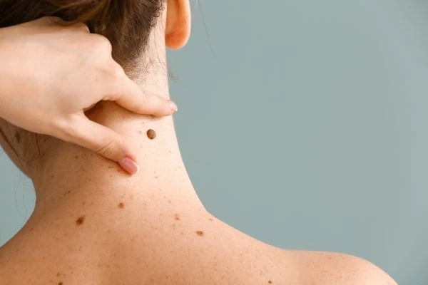 skin blemish removal Herefordshire treatment