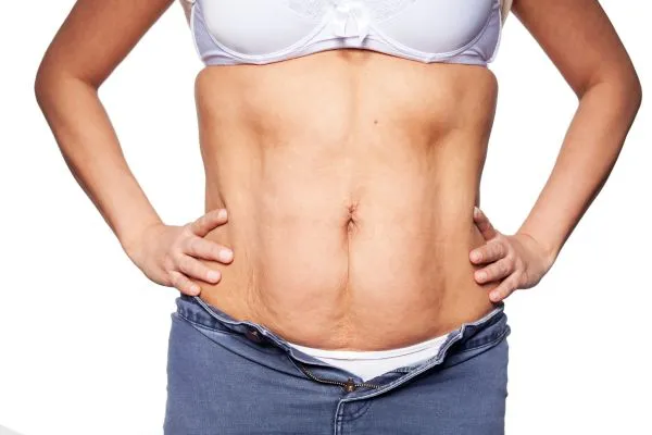 sagging skin on woman's stomach after weight loss injections Herefordshire