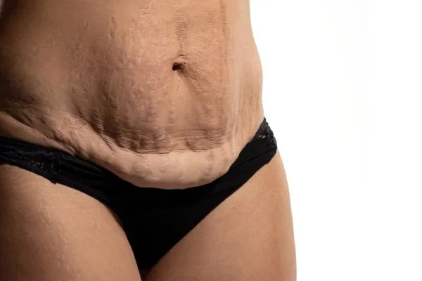 Image of womans stomach after weight loss injections Herefordshire showing saggy skin