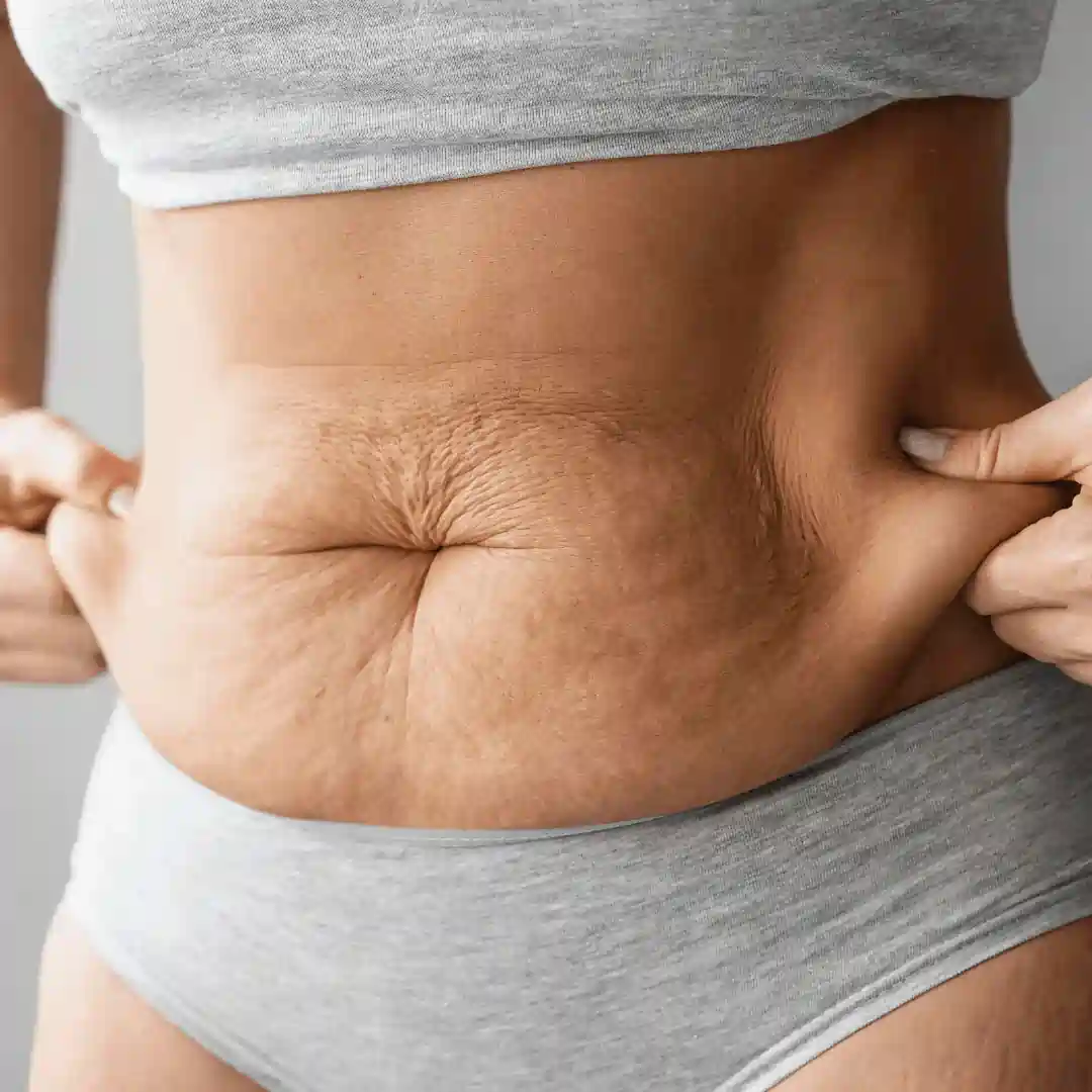 Is It Normal to Have Loose Skin After Pregnancy Herefordshire?