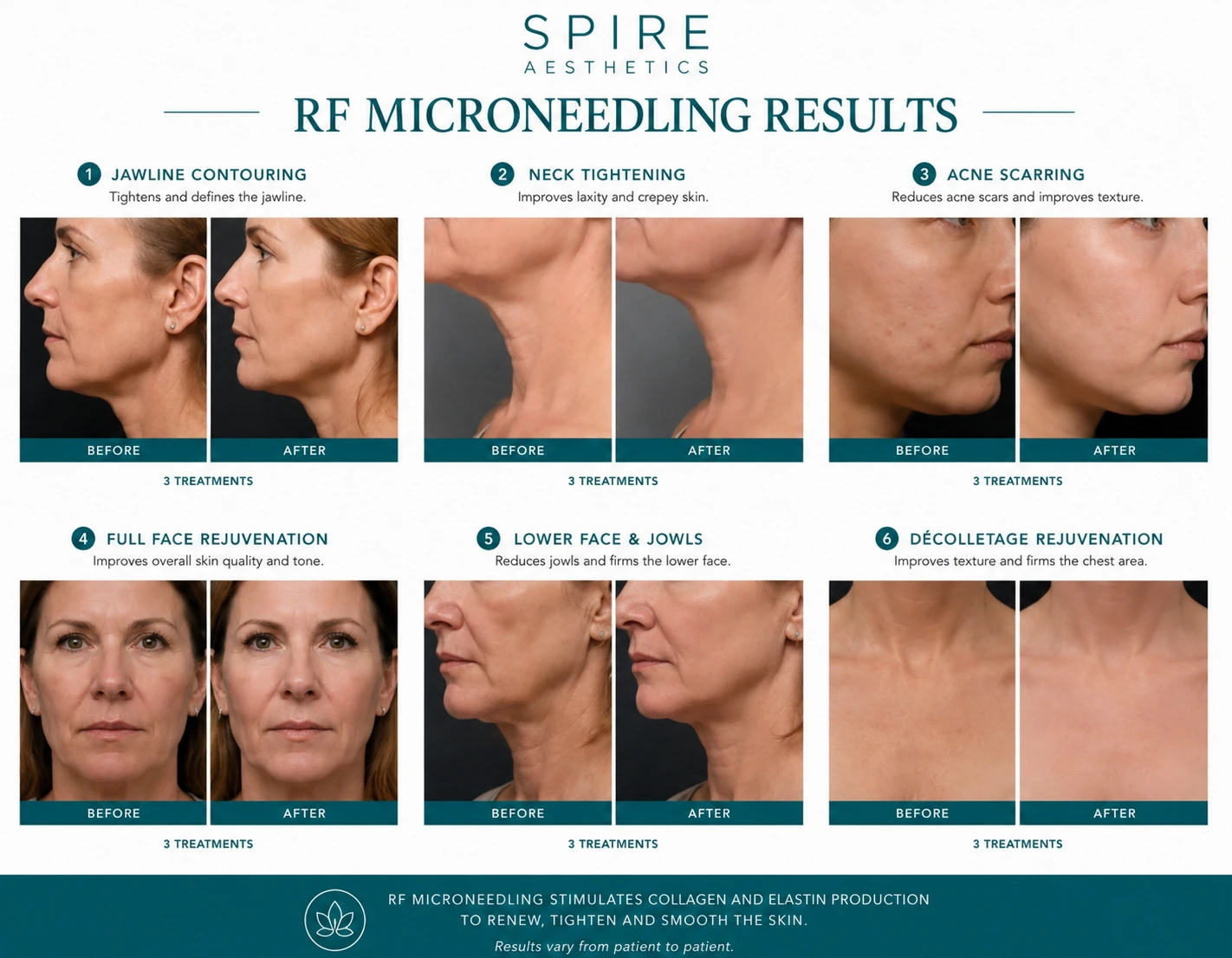 RF Microneedling Skin tightening Herefordshire results