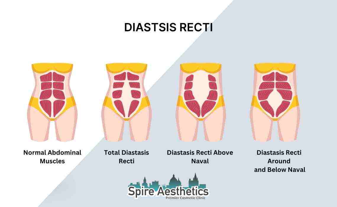 Is Non-Surgical Diastasis Recti Treatment Right for You? Common Concerns Answered Herefordshire